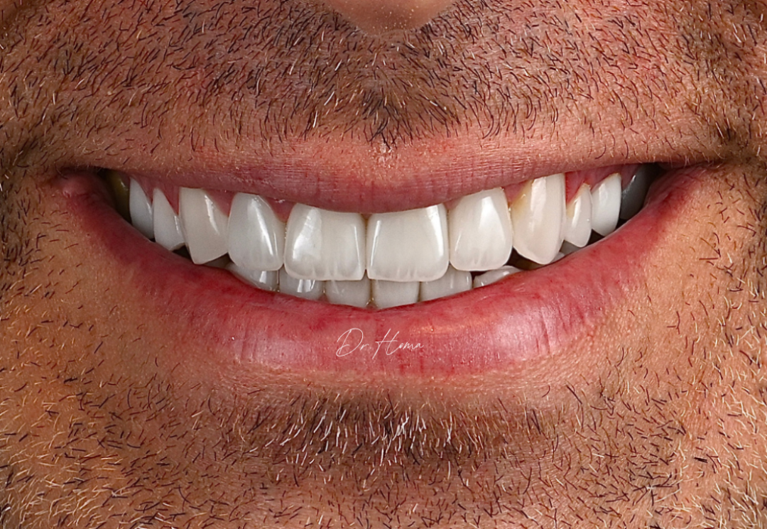 Restore Your Smile with Dental Crowns in Dubai