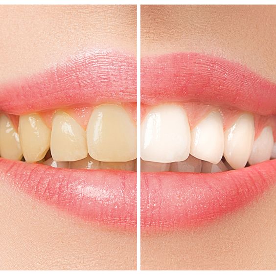 Hollywood smile veneers Dubai before and after