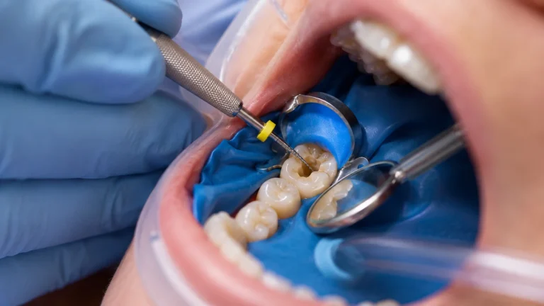 Dentist performing root canal treatment to explain how long the procedure takes