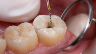Dentist diagnosing pain between two adjacent teeth before root canal treatment